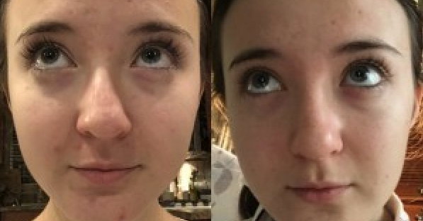 one-month before and after face comparison